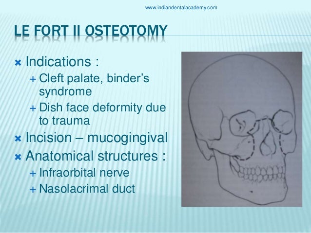 lefort osteotomies
