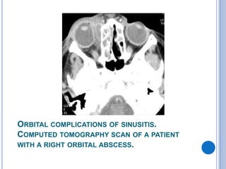 Orbit Abscess Anatomy of the orbit | PPTX