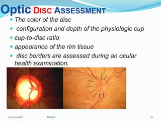 Disc At Risk Anatomy of the Retina.pptx