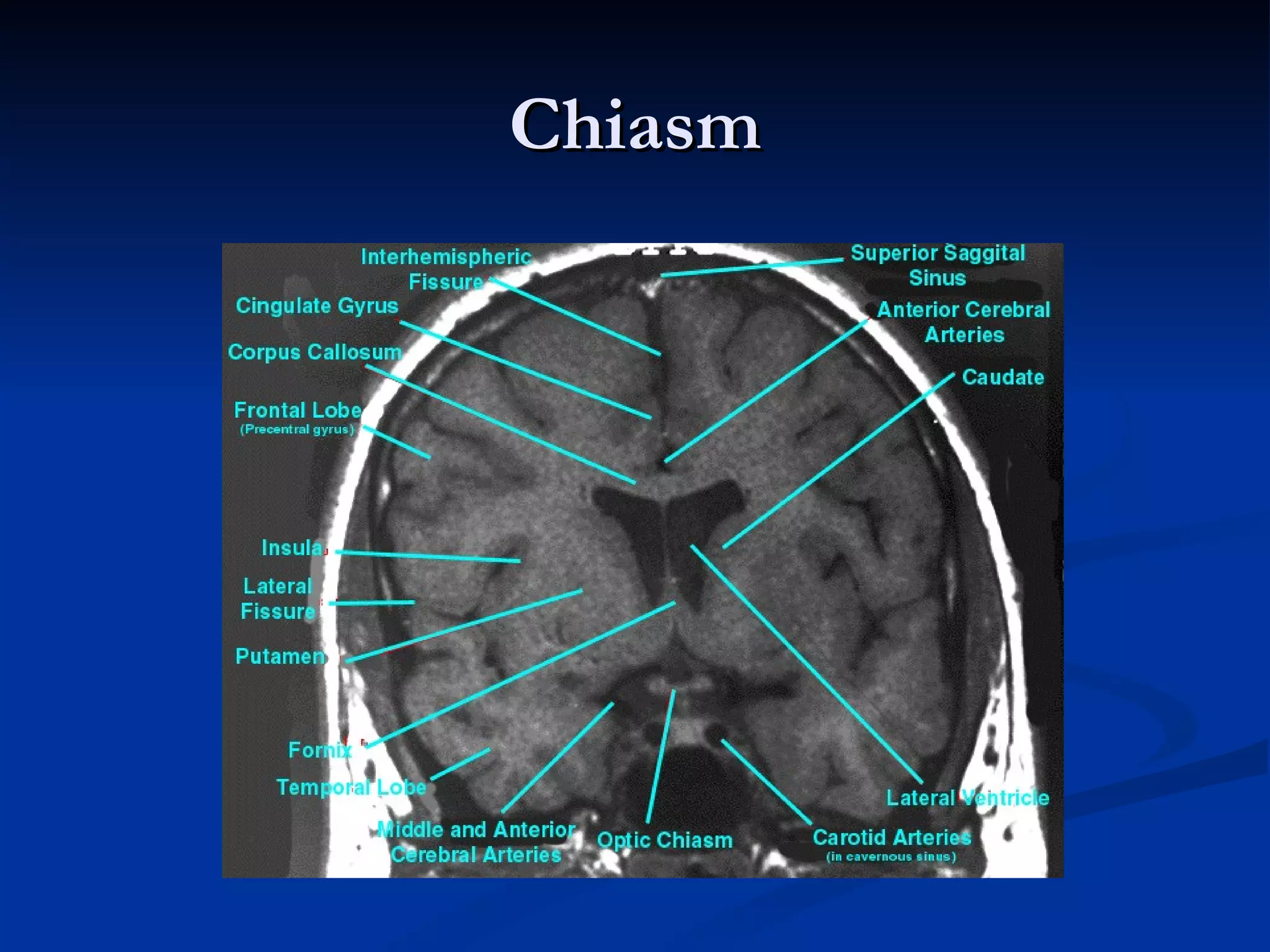 Chiasm
 
