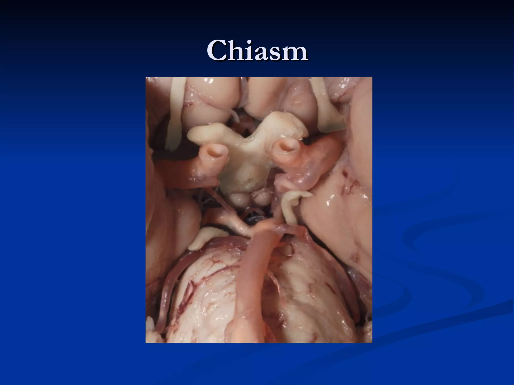 Chiasm
 