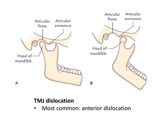 Anatomy of TMJ | PDF
