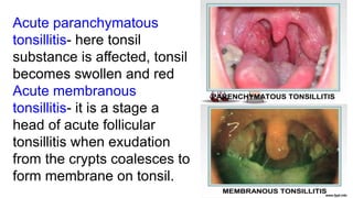 ANATOMY OF TONSIL AND ITS SURGICAL IMPORTANCE.pptx