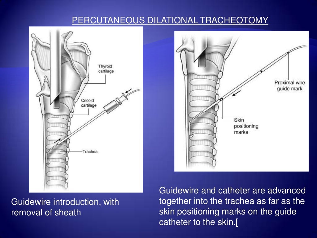 ANATOMY OF TRACHEA & TRACHEOSTOMY