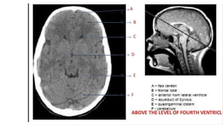 ANATOMY OF VENTRICLES OF BRAIN | PPTX