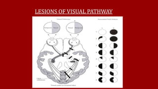 LESIONS OF VISUAL PATHWAY
 
