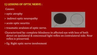 1) LESIONS OF OPTIC NERVE :
Causes:
optic atrophy
 indirect optic neuropathy
acute optic neuritis
traumatic avulsion of optic nerve.
Characterised by: complete blindness in affected eye with loss of both
direct on ipsilateral & concensual light reflex on contralateral side. Near
reflex is preserved.
Eg. Right optic nerve involvement
 