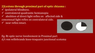 2)Lesions through proximal part of optic chiasma :
 ipsilateral blindness.
 contralateral quadrantic hemianopia
 abolition of direct light reflex on affected side &
concensual light reflex on contralateral side.
 near reflex intact.
Eg. Rt optic nerve Involvement in Proximal part
d/t von willebrands knee-traquairs junctional scotoma
 