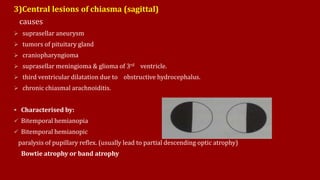 3)Central lesions of chiasma (sagittal)
causes:
 suprasellar aneurysm
 tumors of pituitary gland
 craniopharyngioma
 suprasellar meningioma & glioma of 3rd ventricle.
 third ventricular dilatation due to obstructive hydrocephalus.
 chronic chiasmal arachnoiditis.
 Characterised by:
 Bitemporal hemianopia
 Bitemporal hemianopic
paralysis of pupillary reflex. (usually lead to partial descending optic atrophy)
Bowtie atrophy or band atrophy
 
