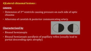 4)Lateral chiasmal lesions :
causes:
• Distension of 3rd ventricle causing pressure on each side of optic
chiasma
• Atheroma of carotids & posterior communicating artery.
Characterised by
• Binasal hemianopia
• Binasal hemianopic parallysis of pupillary reflex (usually lead to
partial descending optic atrophy)
 