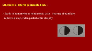 6)Lesions of lateral geniculate body :
 leads to homonymous hemianopia with sparing of pupillary
reflexes & may end in partial optic atrophy.
 