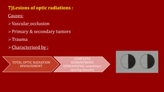 7)Lesions of optic radiations :
Causes:
Vascular occlusion
Primary & secondary tumors
Trauma
Characterised by :
TOTAL OPTIC RADIATION
INVOLVEMENT
COMPLETE
HOMONYMOUS
HEMIANOPIA( sometimes
sparing macula)
 