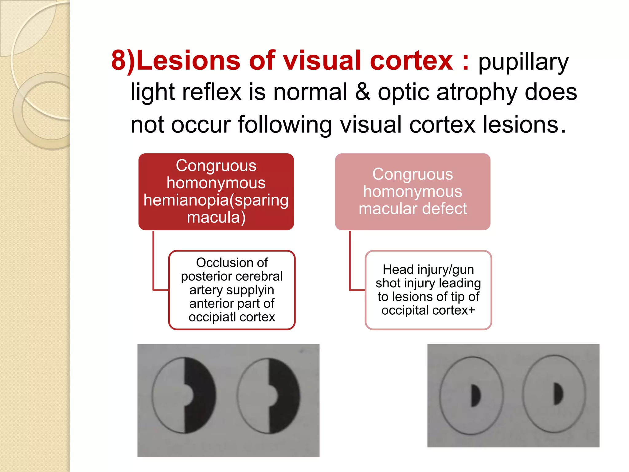 Anatomy of visual pathway and its lesions. | PPTX