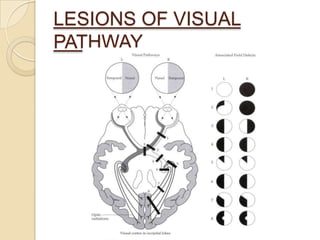 Anatomy of visual pathway and its lesions. | PPTX
