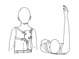 Subclavian grooveOn the medial part of the clavicle is a broad rough surface, the costal tuberosity (rhomboid impression), rather more than 2 cm. in length, for the attachment of the costoclavicular ligament. The rest of this surface is occupied by a groove, which gives attachment to the Subclavius; the coracoclavicular fascia, which splits to enclose the muscle, is attached to the margins of the groove.Not infrequently this groove is subdivided longitudinally by a line which gives attachment to the intermuscular septum of the Subclavius.