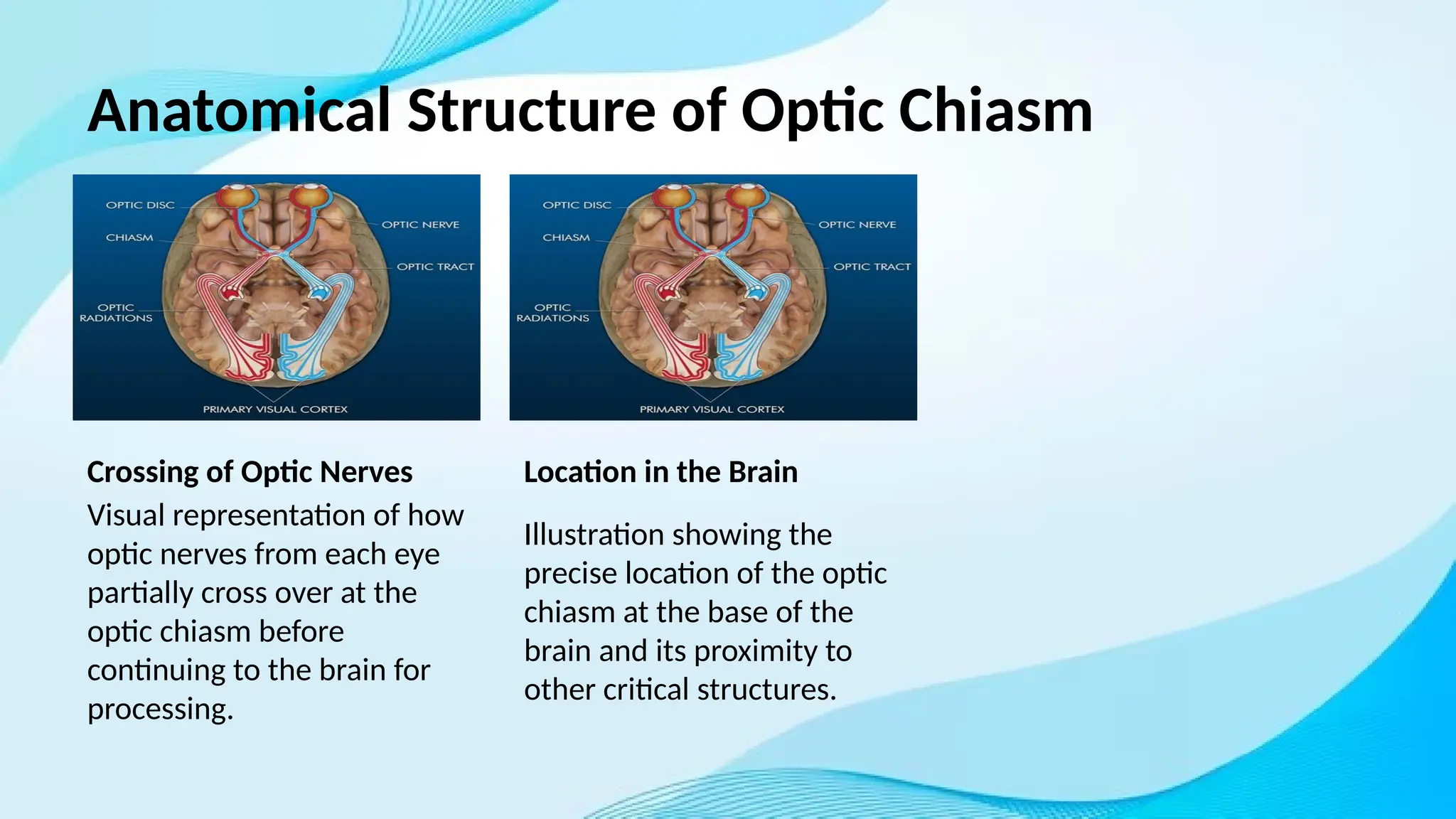 Anatomy, Physiology and lesions of Optic Chaiasma.pptx