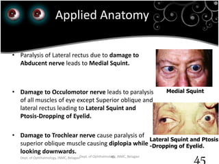 23rd July '15 Dept. of Ophthalmology, JNMC, Belagavi
45
Applied Anatomy
• Abnormal deviation of eyeball is known as Squint
(Strabismus).
• Paralysis of Lateral rectus due to damage to
Abducent nerve leads to Medial Squint.
• Damage to Occulomotor nerve leads to paralysis
of all muscles of eye except Superior oblique and
lateral rectus leading to Lateral Squint and
Ptosis-Dropping of Eyelid.
• Damage to Trochlear nerve cause paralysis of
superior oblique muscle causing diplopia while
looking downwards.
Medial Squint
Lateral Squint and Ptosis
-Dropping of Eyelid.
Dept. of Ophthalmology, JNMC, Belagavi 45
 