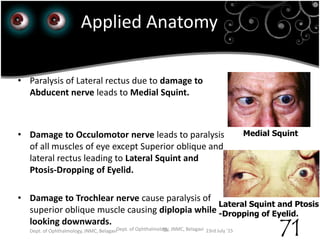 23rd July '15 Dept. of Ophthalmology, JNMC, Belagavi
71
Applied Anatomy
• Abnormal deviation of eyeball is known as Squint
(Strabismus).
• Paralysis of Lateral rectus due to damage to
Abducent nerve leads to Medial Squint.
• Damage to Occulomotor nerve leads to paralysis
of all muscles of eye except Superior oblique and
lateral rectus leading to Lateral Squint and
Ptosis-Dropping of Eyelid.
• Damage to Trochlear nerve cause paralysis of
superior oblique muscle causing diplopia while
looking downwards.
Medial Squint
Lateral Squint and Ptosis
-Dropping of Eyelid.
23rd July '15Dept. of Ophthalmology, JNMC, Belagavi 71
 