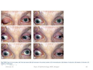 23rd July '15 Dept. of Ophthalmology, JNMC, Belagavi 83
 