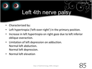 Left 4th nerve palsy
23rd July '15 Dept. of Ophthalmology, JNMC, Belagavi
85
23rdJuly '15
• Characterized by:
• Left hypertropia (‘left-over-right’) in the primary position.
• Increase in left hypertropia on right gaze due to left inferior
oblique overaction.
• Limitation of left depression on adduction.
Normal left abduction.
Normal left depression.
• Normal left elevation
 