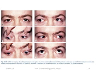 23rd July '15 Dept. of Ophthalmology, JNMC, Belagavi 86
 