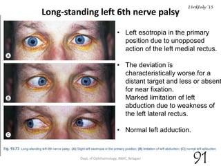 Long-standing left 6th nerve palsy
Dept. of Ophthalmology, JNMC, Belagavi
• Left esotropia in the primary
position due to unopposed
action of the left medial rectus.
• The deviation is
characteristically worse for a
distant target and less or absent
for near fixation.
Marked limitation of left
abduction due to weakness of
the left lateral rectus.
• Normal left adduction.
23rdJuly '15
91
 