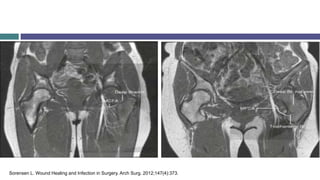 Sorensen L. Wound Healing and Infection in Surgery. Arch Surg. 2012;147(4):373.
 
