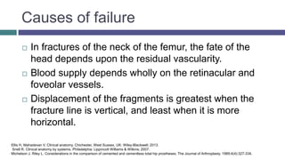 Causes of failure
 In fractures of the neck of the femur, the fate of the
head depends upon the residual vascularity.
 Blood supply depends wholly on the retinacular and
foveolar vessels.
 Displacement of the fragments is greatest when the
fracture line is vertical, and least when it is more
horizontal.
Ellis H, Mahadevan V. Clinical anatomy. Chichester, West Sussex, UK: Wiley-Blackwell; 2013.
Snell R. Clinical anatomy by systems. Philadelphia: Lippincott Williams & Wilkins; 2007.
Michelson J, Riley L. Considerations in the comparison of cemented and cementless total hip prostheses. The Journal of Arthroplasty. 1989;4(4):327-334.
 