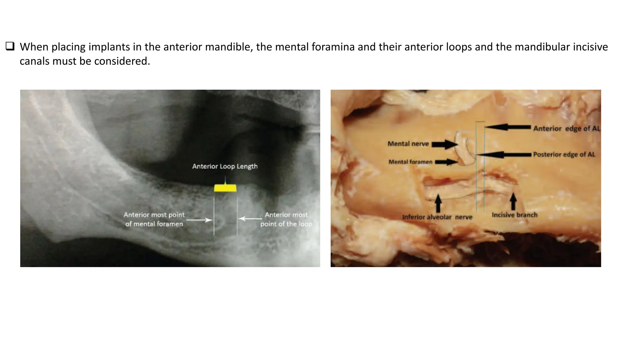 Anatomy relevent to Dental Implantology.pdf