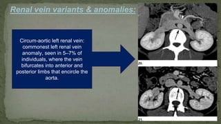 Renal vein variants & anomalies:
Circum-aortic left renal vein:
commonest left renal vein
anomaly, seen in 5–7% of
individuals, where the vein
bifurcates into anterior and
posterior limbs that encircle the
aorta.
 