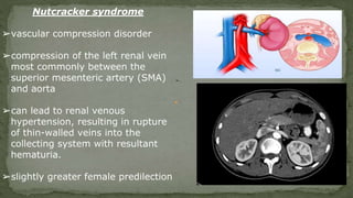 ➢.
Nutcracker syndrome
➢vascular compression disorder
➢compression of the left renal vein
most commonly between the
superior mesenteric artery (SMA)
and aorta
➢can lead to renal venous
hypertension, resulting in rupture
of thin-walled veins into the
collecting system with resultant
hematuria.
➢slightly greater female predilection
 