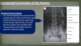Congenital anomalies of the kidney:
Crossed fused ectopia:
• IVU demonstrating left crossed fused
ectopia due to fusion of the lower pole
of the left kidney with the upper pole
of the ectopic right kidney, but note
that the ureters are normally sited.
• These kidneys invariably have an
aberrant vascular supply.
 