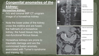 Horseshoe kidney:
• IVU and coronal MIP CT urogram
image of a horseshoe kidney
• Note the lower poles of the kidney
cross the midline and are fused,
the hallmark of a horseshoe
kidney; the fused tissue may be
non-functional fibrous tissue.
• Horseshoe kidneys are prone to
traumatic damage and are the
commonest fusion anomaly,
associated with Turner’s syndrome
and trisomy 18.
Congenital anomalies of the
kidney:
 