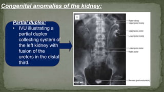 Partial duplex:
• IVU illustrating a
partial duplex
collecting system of
the left kidney with
fusion of the
ureters in the distal
third.
Congenital anomalies of the kidney:
 