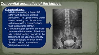 Complete duplex:
• IVU demonstrating a duplex left
kidney with complete ureteric
duplication. The upper moiety ureter
is seen entering the bladder as a
ureterocele with a typical ‘cobra’s
head’ appearance (arrow).
• Complete duplex systems are more
common with the ureter of the lower
pole moiety inserting normally in the
bladder and the upper pole moiety
having an ectopic insertion in the
bladder, urethra or elsewhere
(Weigert-Meyer law).
Congenital anomalies of the kidney:
 
