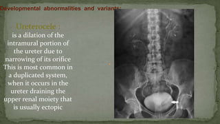 Ureterocele :
is a dilation of the
intramural portion of
the ureter due to
narrowing of its orifice
This is most common in
a duplicated system,
when it occurs in the
ureter draining the
upper renal moiety that
is usually ectopic
 