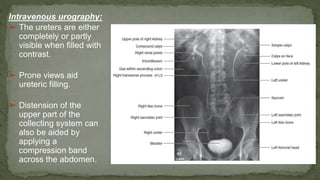 Intravenous urography:
➢ The ureters are either
completely or partly
visible when filled with
contrast.
➢ Prone views aid
ureteric filling.
➢ Distension of the
upper part of the
collecting system can
also be aided by
applying a
compression band
across the abdomen.
 