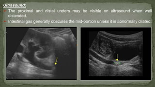 Ultrasound:
➢ The proximal and distal ureters may be visible on ultrasound when well
distended.
➢ Intestinal gas generally obscures the mid-portion unless it is abnormally dilated.
 