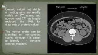 CT:
➢ Ureteric calculi not visible
on radiographs are readily
visible on CT scans, and
non-contrast CT has largely
replaced the IVU for
diagnosis of ureteric calculi
➢ The normal ureter can be
identified on non-contrast
scans, although it is easier
to identify if it contains
contrast medium.
.
 