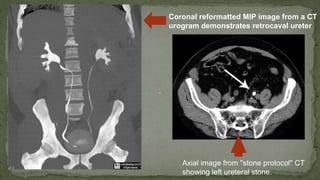 Coronal reformatted MIP image from a CT
urogram demonstrates retrocaval ureter
Axial image from "stone protocol" CT
showing left ureteral stone.
 