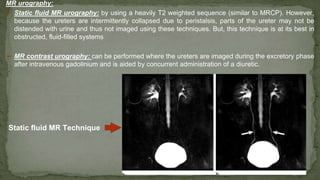 MR urography:
➢ Static fluid MR urography: by using a heavily T2 weighted sequence (similar to MRCP). However,
because the ureters are intermittently collapsed due to peristalsis, parts of the ureter may not be
distended with urine and thus not imaged using these techniques. But, this technique is at its best in
obstructed, fluid-filled systems
➢ MR contrast urography: can be performed where the ureters are imaged during the excretory phase
after intravenous gadolinium and is aided by concurrent administration of a diuretic.
Static fluid MR Technique
 