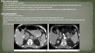 Right adrenal gland.
➢ More consistent in location.
➢ It lies posterior to IVC, medial to the right lobe of the liver and lateral to the right diaphragmatic crus.
➢ It is lower and more medial in relation to the spine than the left.
➢ On cross-section, it is linear or V-shaped, with a larger medial limb and a smaller lateral limb
Left adrenal gland:
➢ Less constant in location.
➢ Usually lies posterior to the splenic vein and lateral to the diaphragmatic crus.
➢ More semilunar than the right and it extends down the superomedial border of the kidney towards the
hilum.
➢ On cross-section it is triangular or Y-shaped.
 