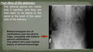 Plain films of the abdomen:
➢ The adrenal glands are visible
only if calcified, and they are
then seen to be lateral to the
spine at the level of the upper
pole of the kidneys.
Bilateral triangular foci of
calcifications near the adrenal
lodge, compatible with bilateral
adrenal calcifications.
This patient had a past medical
history of adrenal hemorrhage.
 
