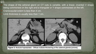 CT:
➢ The shape of the adrenal gland on CT cuts is variable, with a linear, inverted V shape
being commonest on the right and a triangular or Y shape commonest on the left.
➢ Craniocaudal extent is less than 4 cm.
➢ Limb thickness is usually less than 1 cm.
 