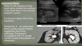 Extrarenal Pelvis:
➢ Refers to the presence of the
renal pelvis outside the confines
of the renal hilum; it is a normal
anatomic variant
➢ It is found in about 10% of the
population.
➢ Ultrasound  an extra-renal
pelvis usually appears dilated,
suggesting obstructive
pathology. Subsequent
investigation with CT usually
clarifies a false interpretation on
ultrasound.
 