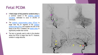 Pcom Cta anatomy vasculature.pptx