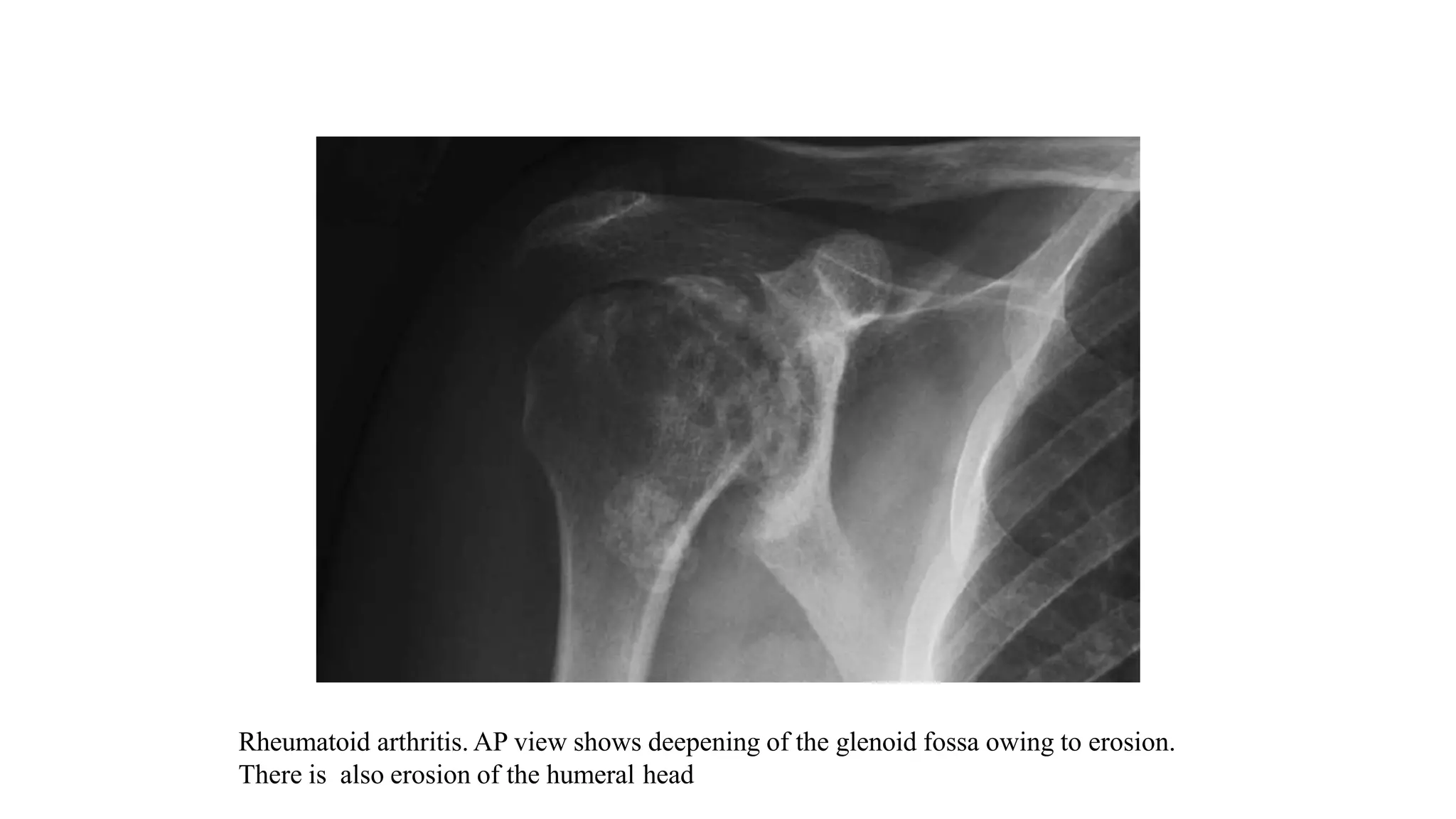 Rheumatoid arthritis. AP view shows deepening of the glenoid fossa owing to erosion.
There is also erosion of the humeral head
 