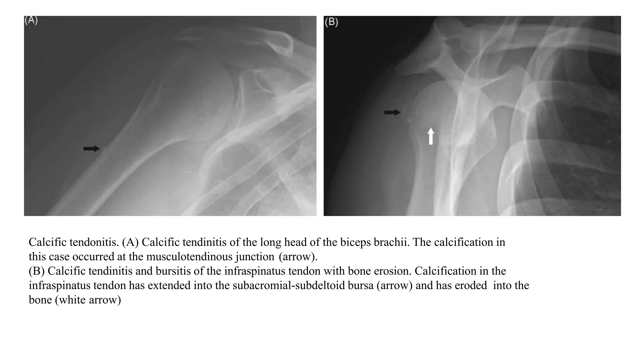 Calcific tendonitis. (A) Calcific tendinitis of the long head of the biceps brachii. The calcification in
this case occurred at the musculotendinous junction (arrow).
(B) Calcific tendinitis and bursitis of the infraspinatus tendon with bone erosion. Calcification in the
infraspinatus tendon has extended into the subacromial-subdeltoid bursa (arrow) and has eroded into the
bone (white arrow)
 