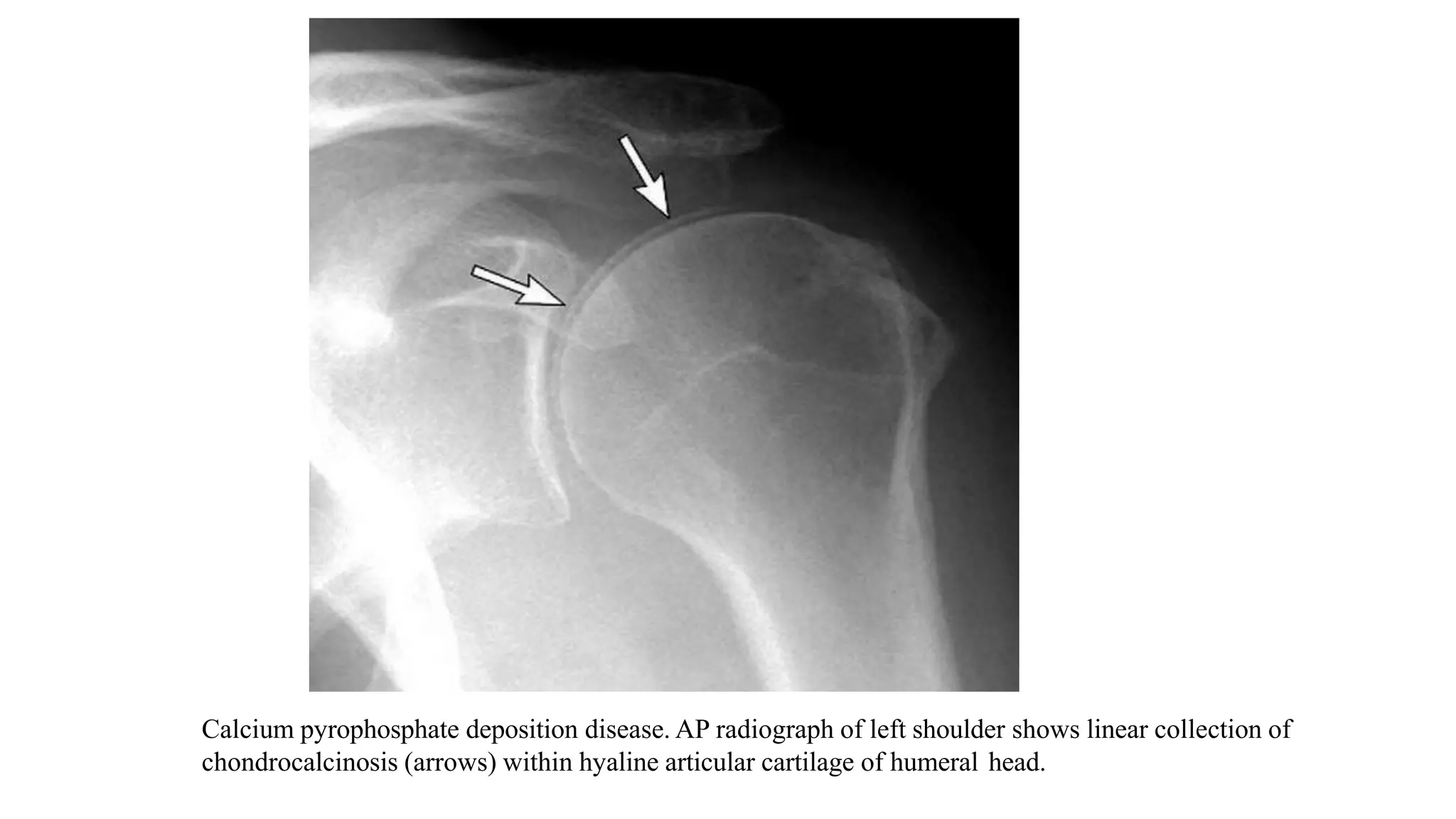 Calcium pyrophosphate deposition disease. AP radiograph of left shoulder shows linear collection of
chondrocalcinosis (arrows) within hyaline articular cartilage of humeral head.
 
