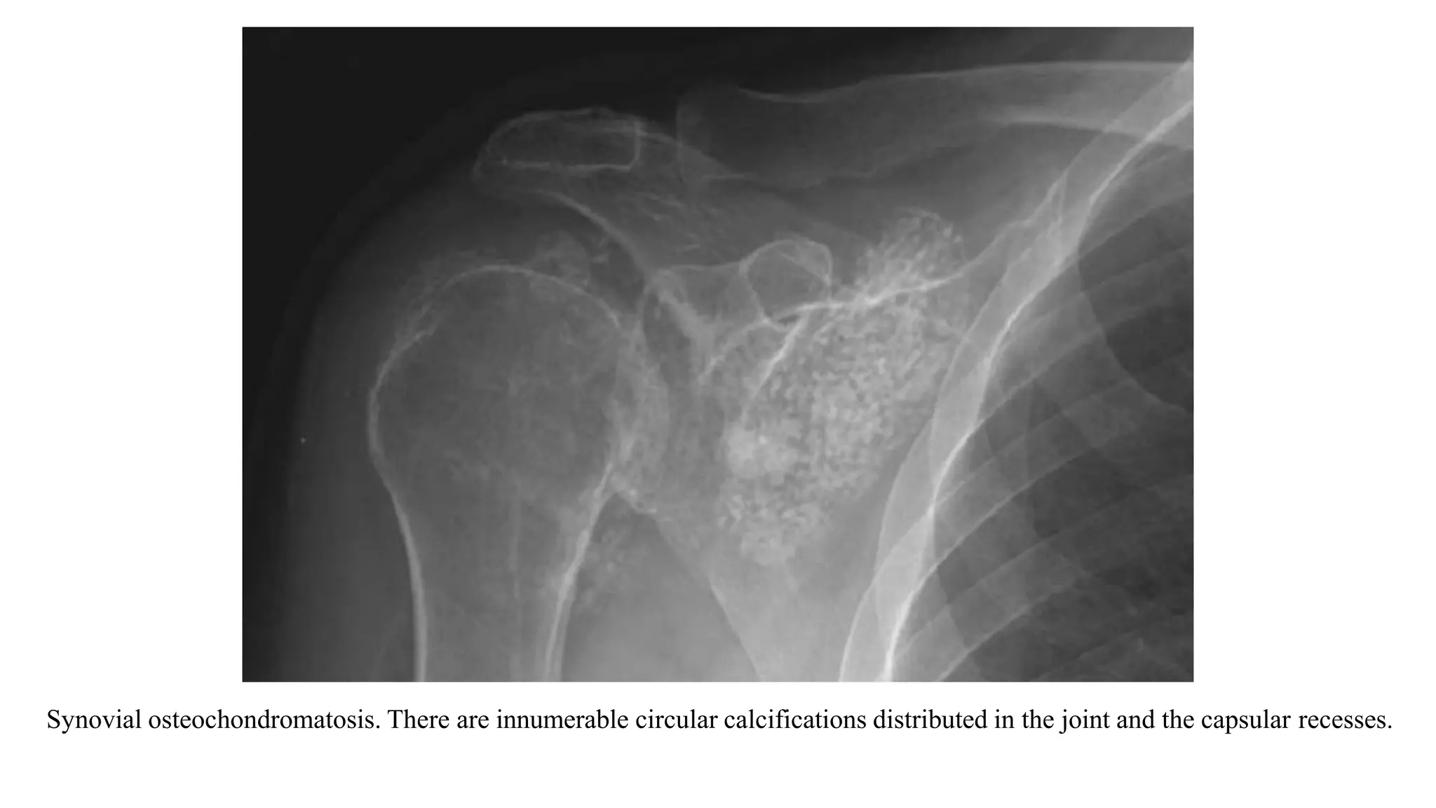 Synovial osteochondromatosis. There are innumerable circular calcifications distributed in the joint and the capsular recesses.
 